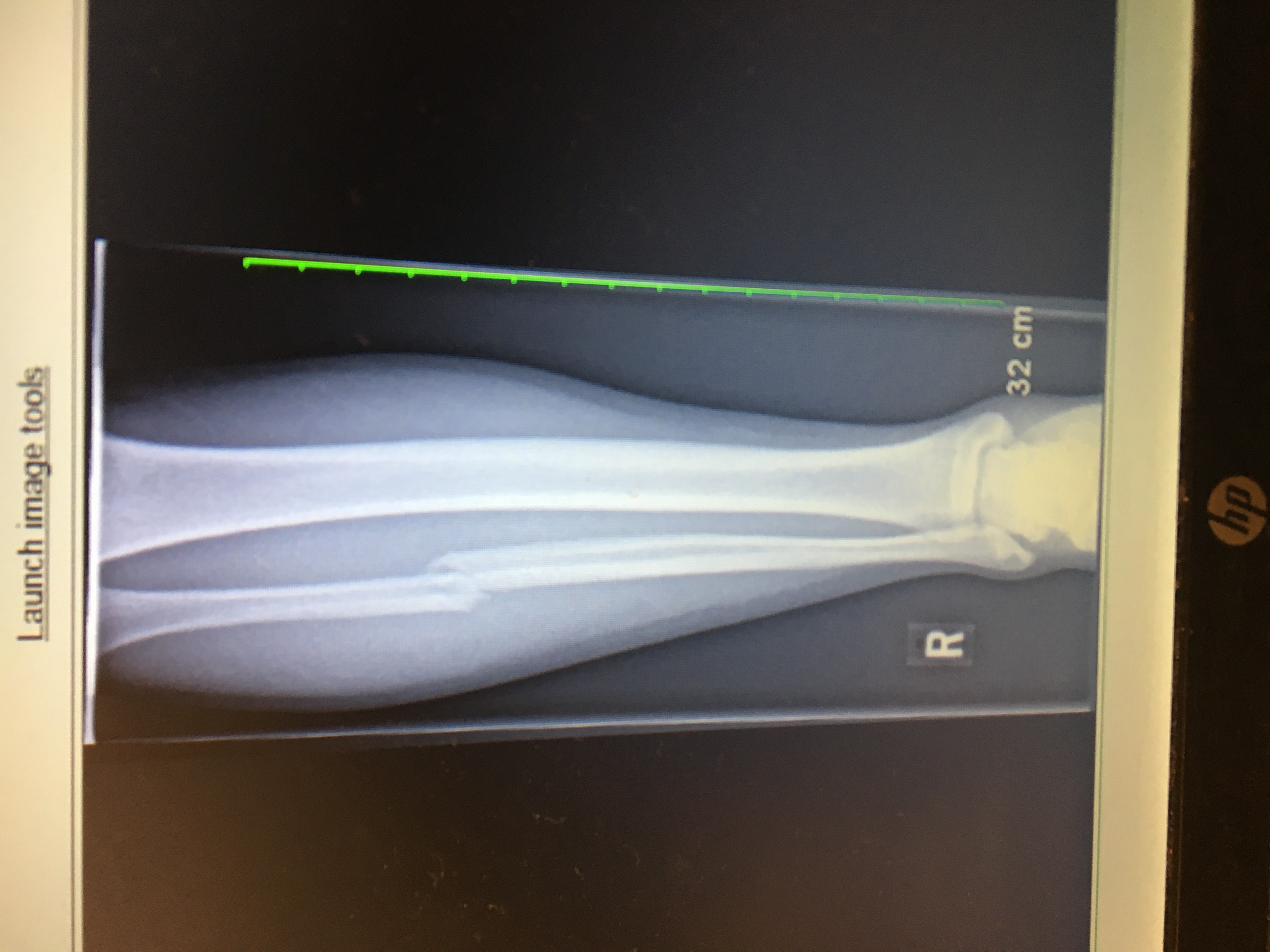 X-ray of Ryan&rsquo;s broken leg